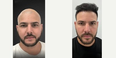 Hair Transplant before and after photo
