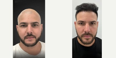 Hair Transplant before and after photo