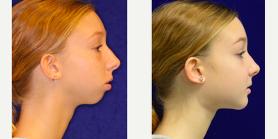 Jaw Surgery before and after photo