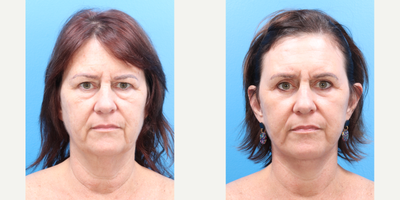 Laser Resurfacing before and after photo