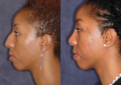 African American Rhinoplasty before and after photo