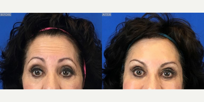 Botox before and after photo