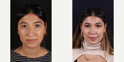 Buccal Fat Removal before and after photo