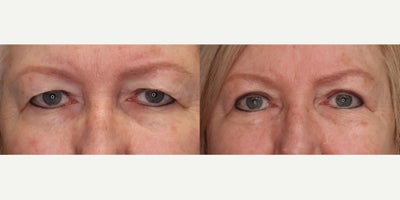 Eyelid Surgery before and after photo