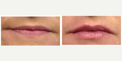 Lip Fillers before and after photo