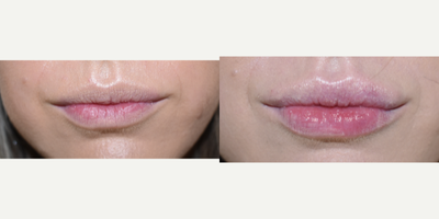 Restylane Lyft before and after photo