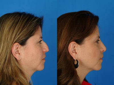 Rhinoplasty before and after photo