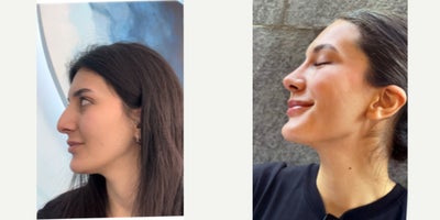 Rhinoplasty before and after photo