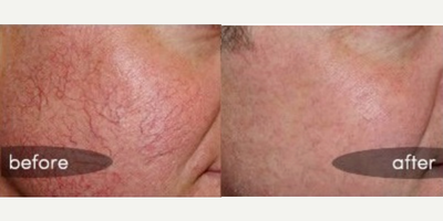 Sclerotherapy before and after photo