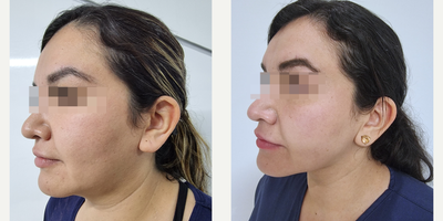 Buccal Fat Removal before and after photo
