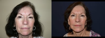 Facelift before and after photo