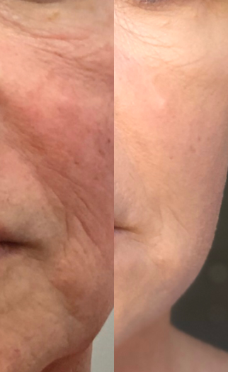 Microneedling RF before and after photo