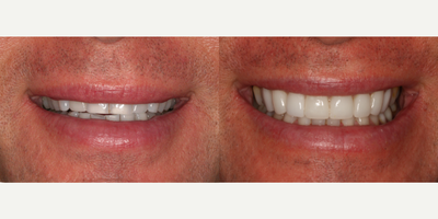 Porcelain Veneers before and after photo