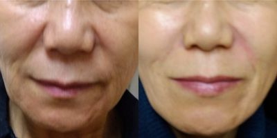 Radiesse before and after photo
