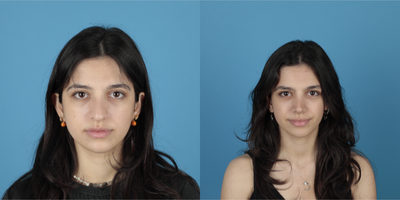 Rhinoplasty before and after photo