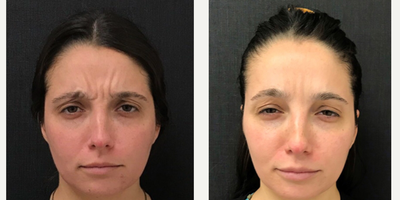 Botox before and after photo