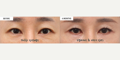 Eyelid Surgery before and after photo
