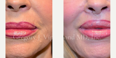 Lip Lift before and after photo