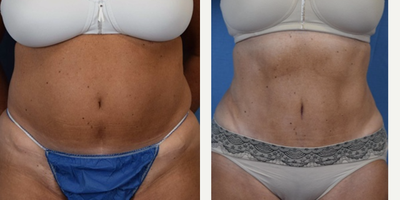 Liposuction before and after photo
