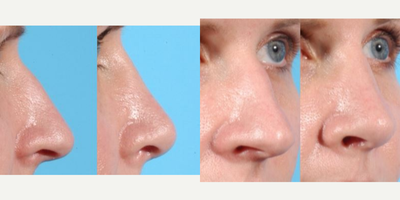 Rhinoplasty before and after photo