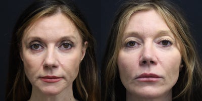 Rhinoplasty before and after photo
