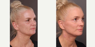 Botox before and after photo