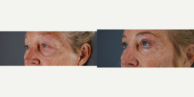 Eyelid Surgery before and after photo