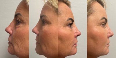 Eyelid Surgery before and after photo
