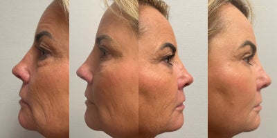 Eyelid Surgery before and after photo