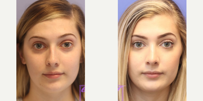 Rhinoplasty before and after photo