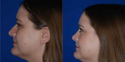 Rhinoplasty before and after photo