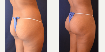 Brazilian Butt Lift before and after photo