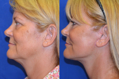 Laser Resurfacing before and after photo