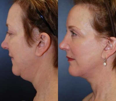 Neck Lift before and after photo