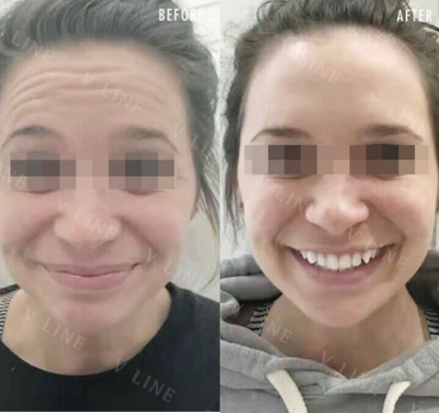 Botox before and after photo