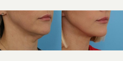 Neck Lift before and after photo