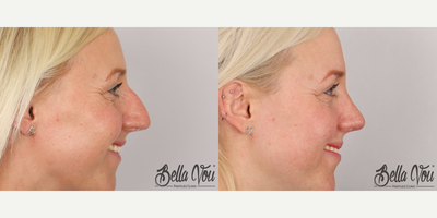 Rhinoplasty before and after photo