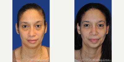 Rhinoplasty before and after photo