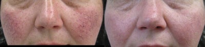 Sclerotherapy before and after photo