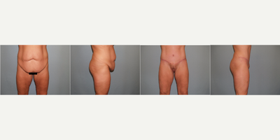 Tummy Tuck before and after photo