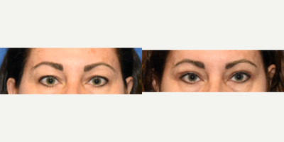 Eyelid Surgery before and after photo