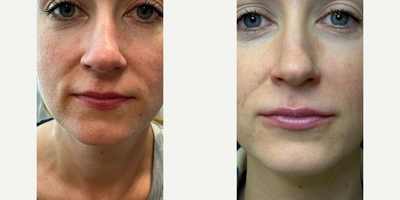 Juvederm before and after photo