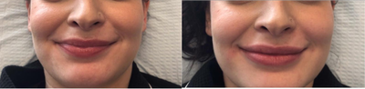 Lip Fillers before and after photo