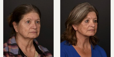 Neck Lift before and after photo
