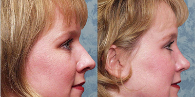 Rhinoplasty before and after photo