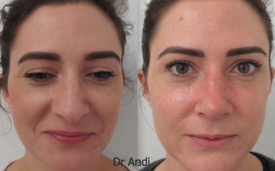 Rhinoplasty before and after photo