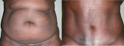 Tummy Tuck before and after photo