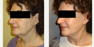 Facelift before and after photo