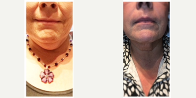 Kybella before and after photo