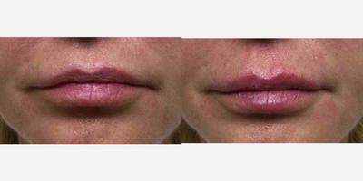 Lip Fillers before and after photo